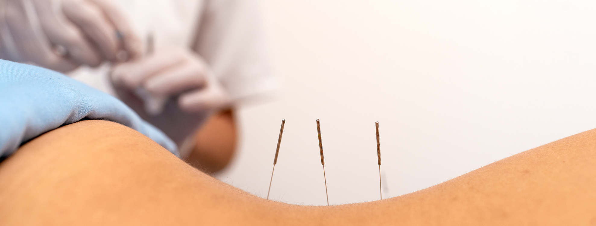 Akupunkturbehandlung beim Heilpraktiker in Hilden, Düsseldorf für Gesundheit und Wohlbefinden.